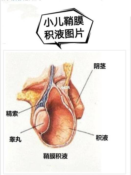 小儿鞘膜积液