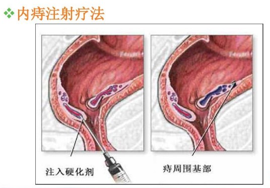 内痔注射疗法