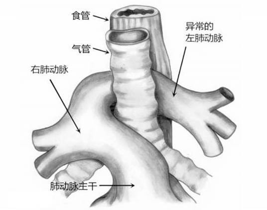 肺动脉吊带