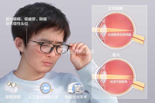 散光