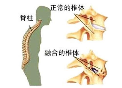 强脊炎
