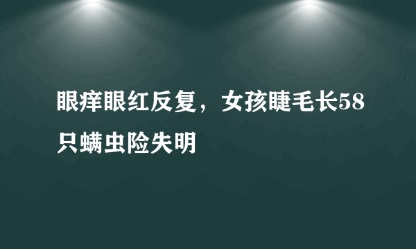 眼痒眼红反复，女孩睫毛长58只螨虫险失明