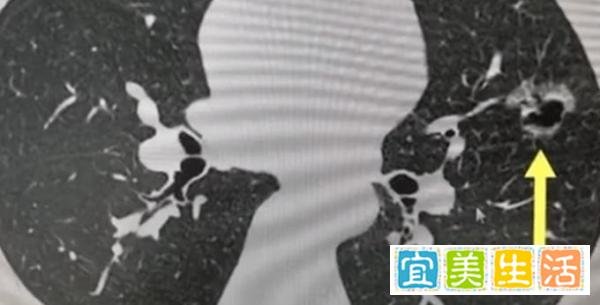 女子长期吸同事二手烟肺部长肿块 这是咋情况？